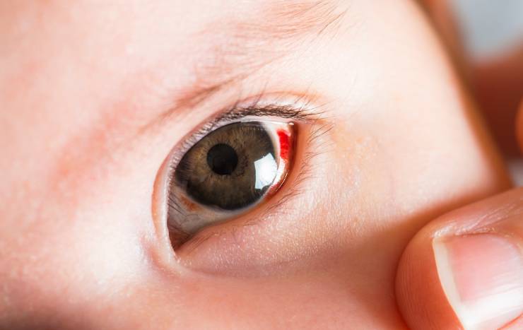 Conjuntivitis en las piletas: cuáles son síntomas y cómo se previene