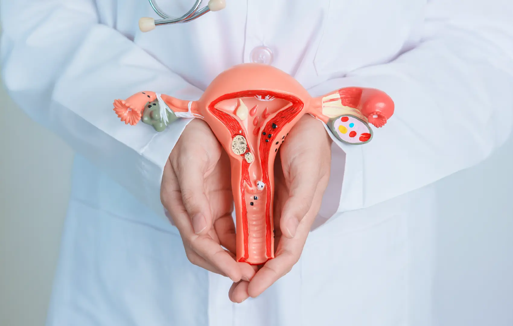 Endometriosis: una enfermedad frecuente que merece diagnóstico y tratamiento oportuno